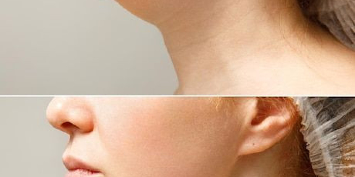 Jaw Surgery in Islamabad – Restore Jaw Function and Facial Symmetry